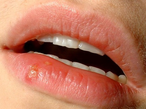 Oral Herpes is More Common Than You Think