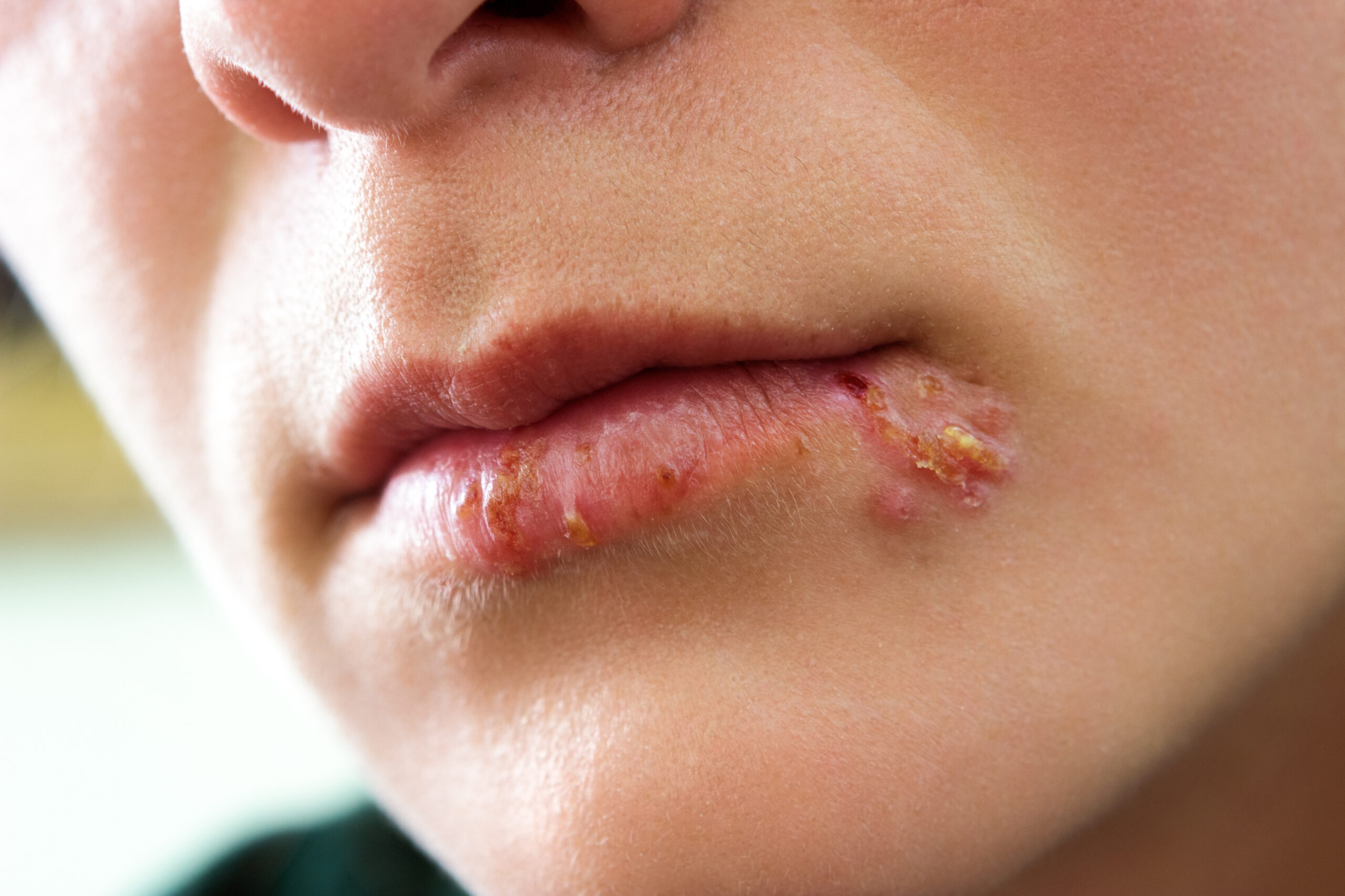 Woman with oral herpes infection