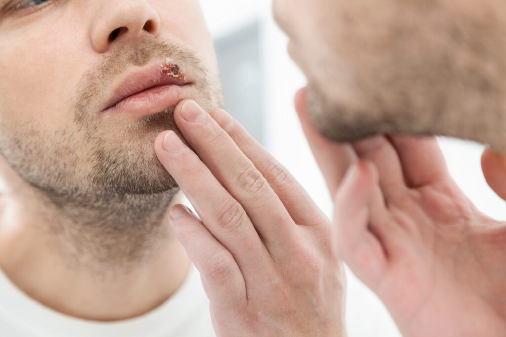 Understanding herpes simplex