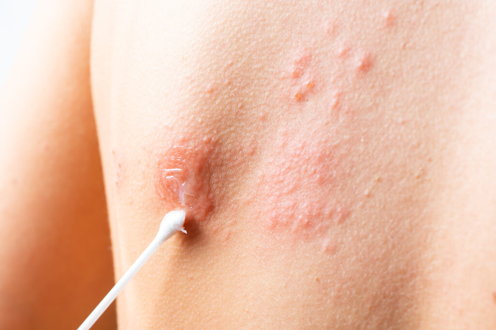 herpes on buttocks