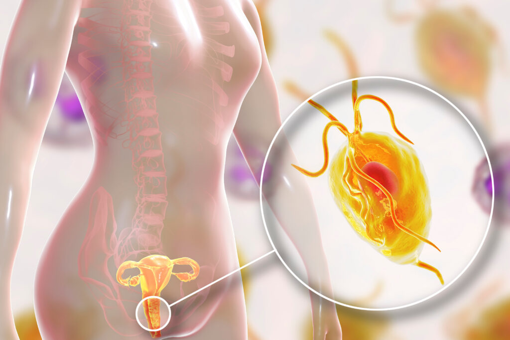 trichomoniasis