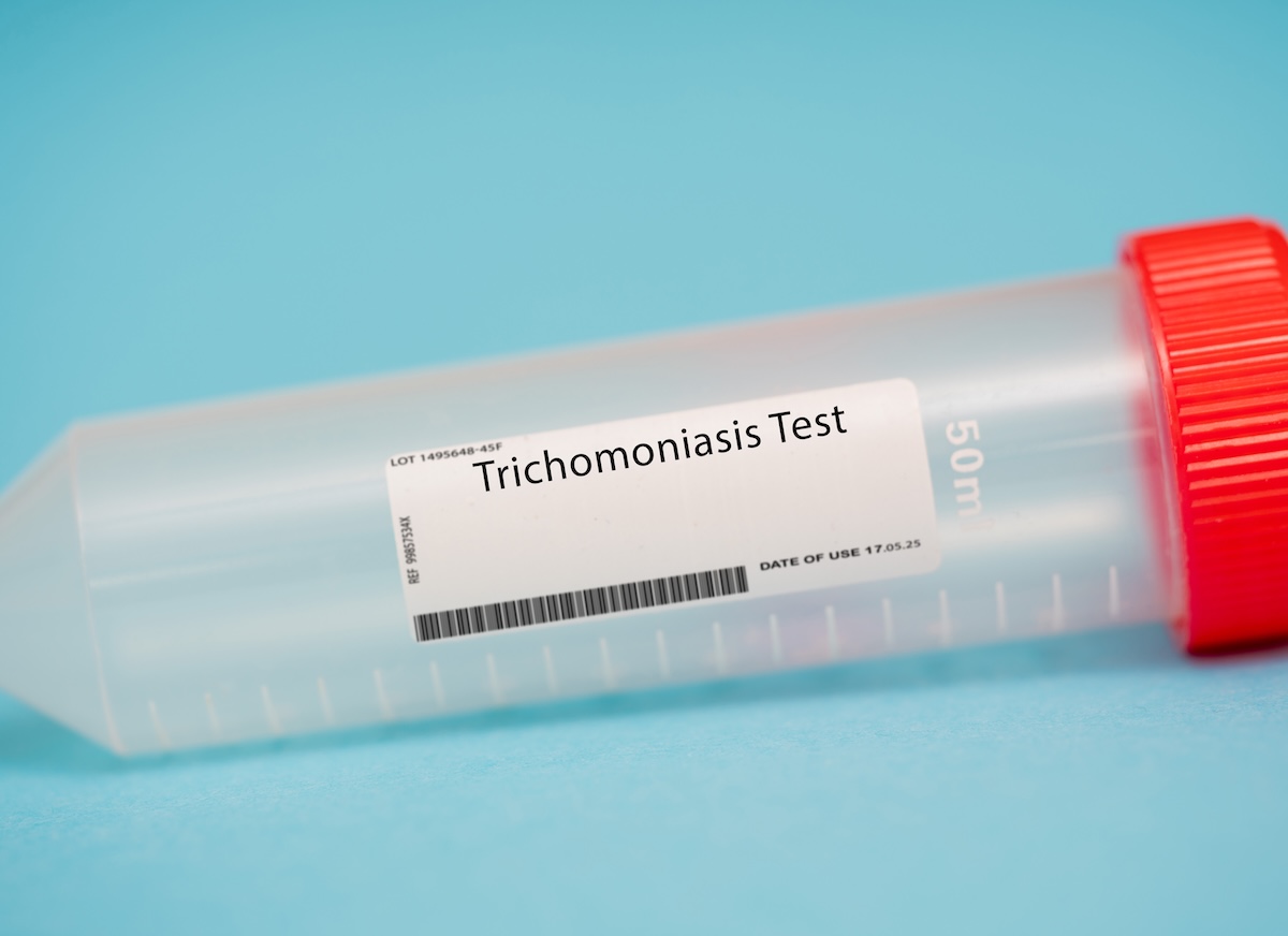 Trichomoniasis test