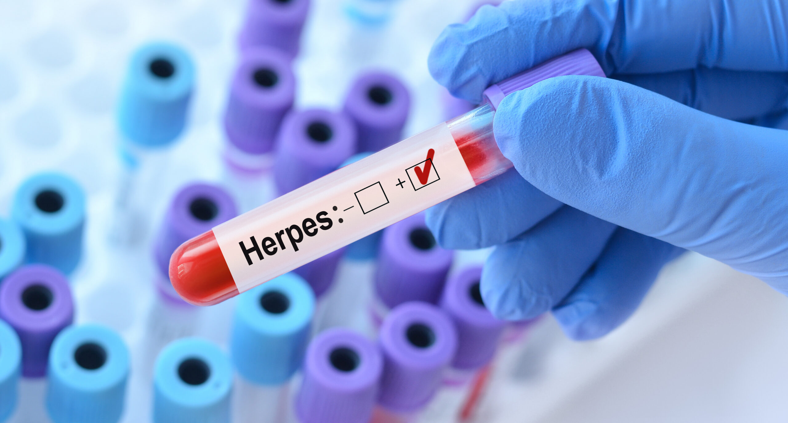 Herpes Test