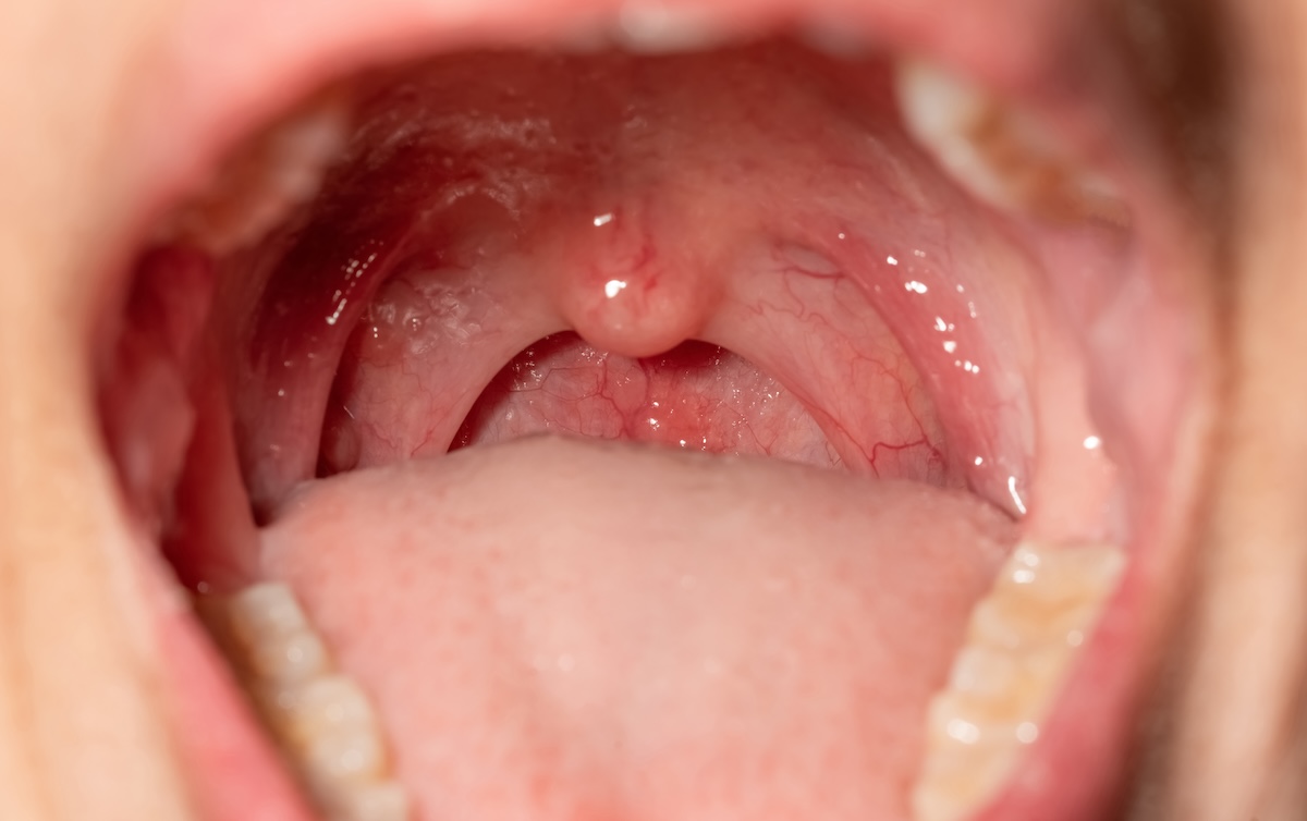 sore throat std